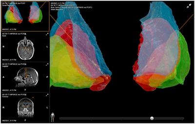 Deep brain stimulation programming for intractable obsessive–compulsive disorder using a long pulse width